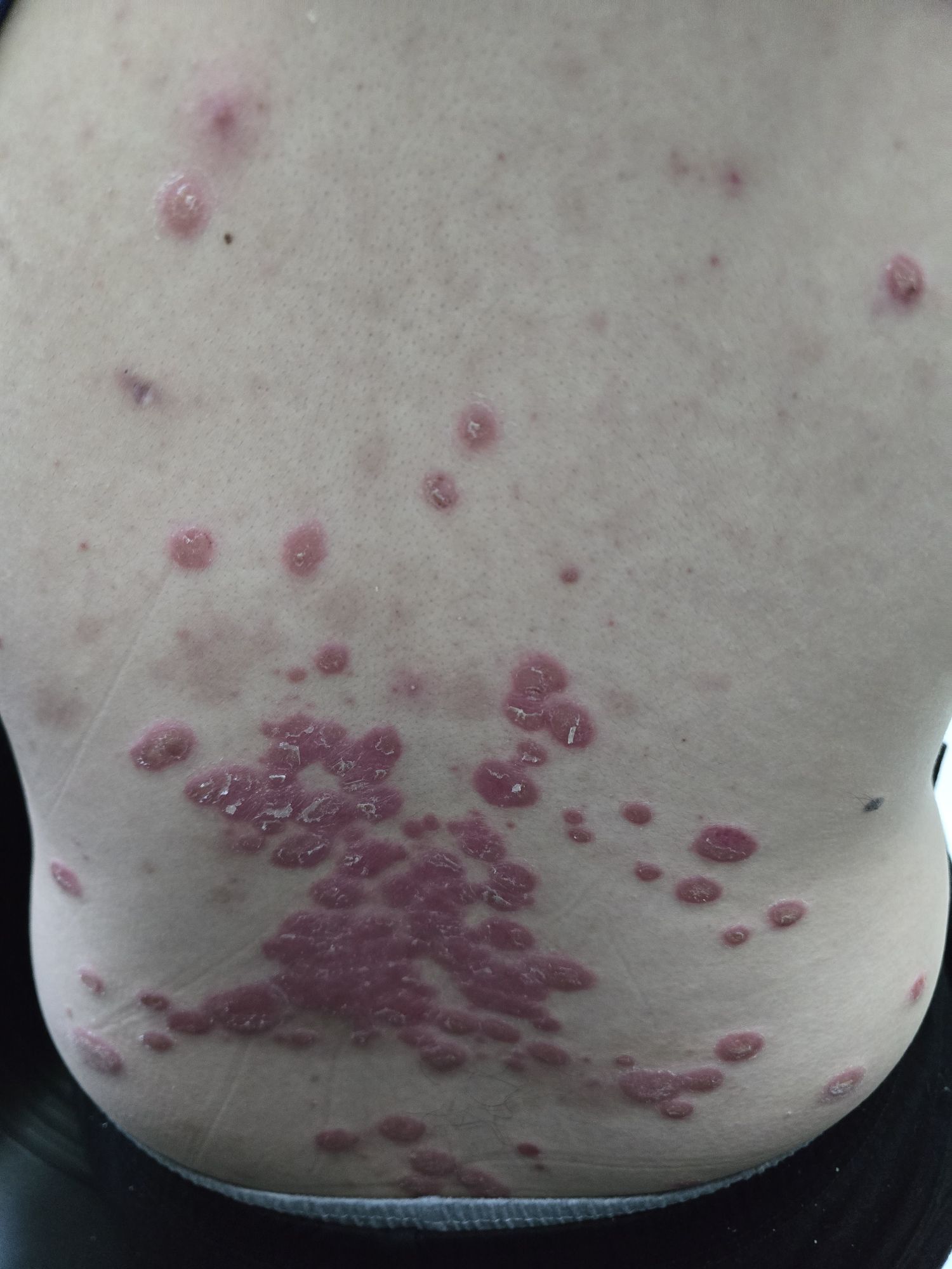 Exploring the Potential of Mesenchymal Stem Cells (MSCs) in Psoriasis Treatment